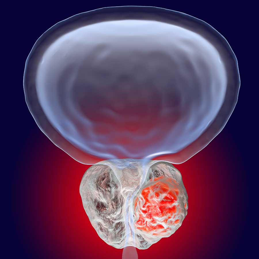 Online PHI Prostate Test